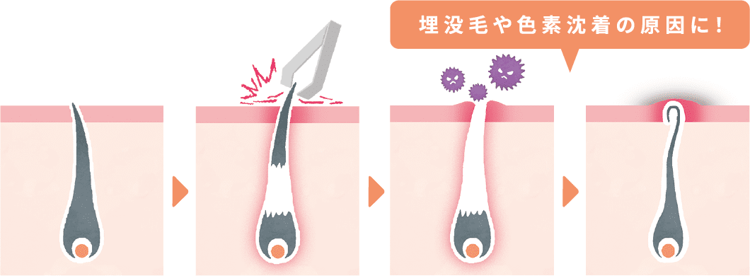 埋没毛や色素沈着など、ワキのムダ毛の自己処理のリスクの図。