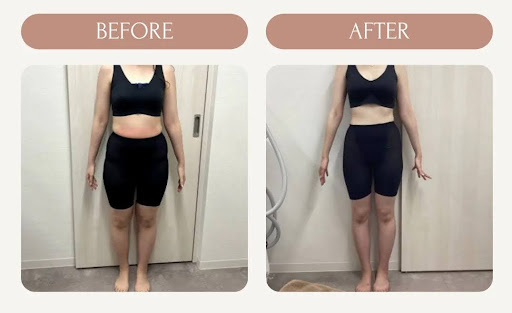 脂肪冷却の症例写真