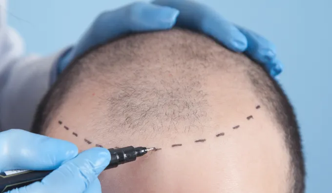 植毛 マーキング