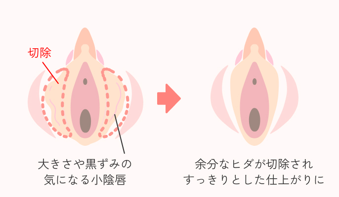 小陰唇縮小術の説明