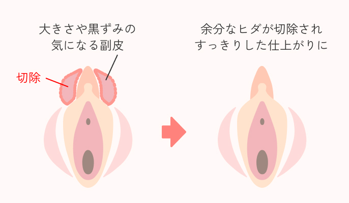 副皮切除の説明