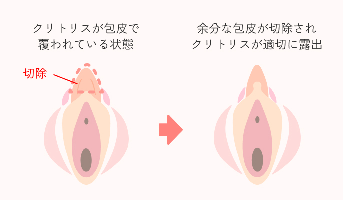 クリトリス包茎手術の説明