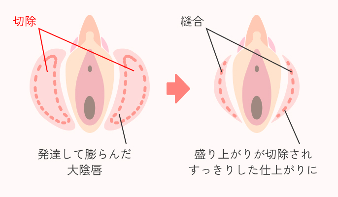 大陰唇縮小術の説明