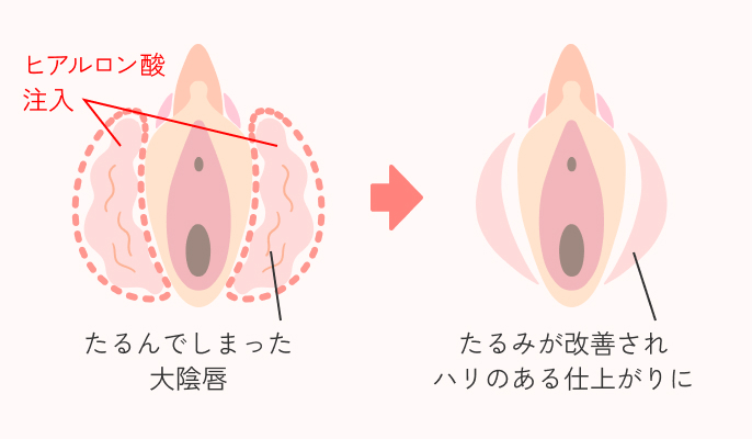 大陰唇ヒアルロン酸の説明