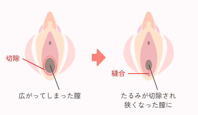 膣縮小手術の説明