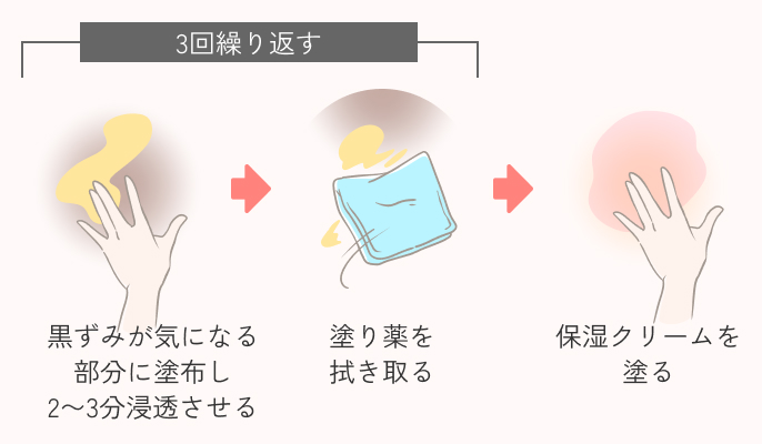 黒ずみ治療の施術説明