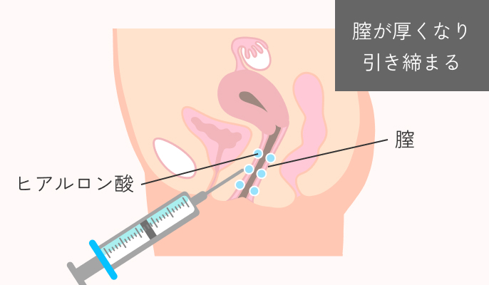 膣ヒアルロン酸の施術説明