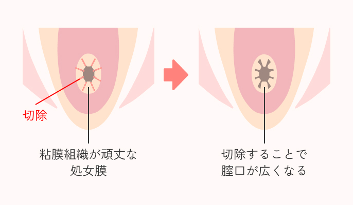 処女膜切開の施術説明