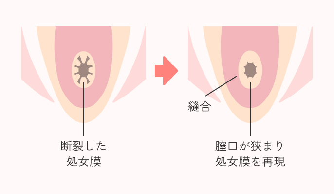 処女膜再生手術の施術説明