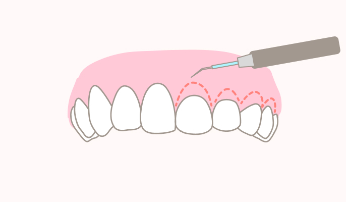 歯肉整形の施術説明