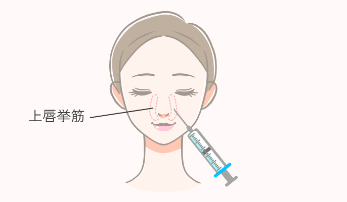 ガミースマイル治療の施術説明