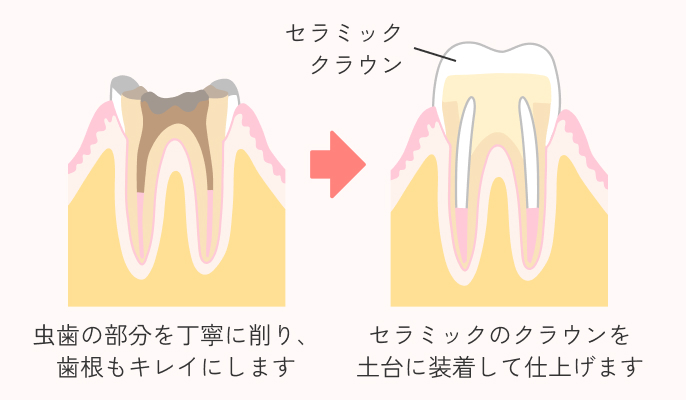 セラミッククラウンの施術説明