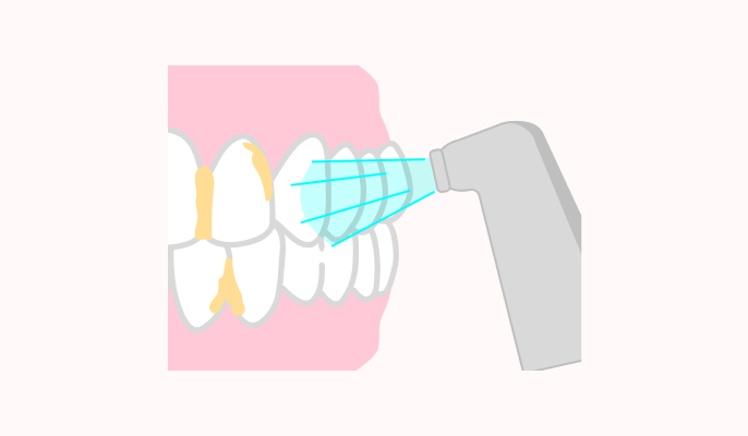 エアフローの施術説明