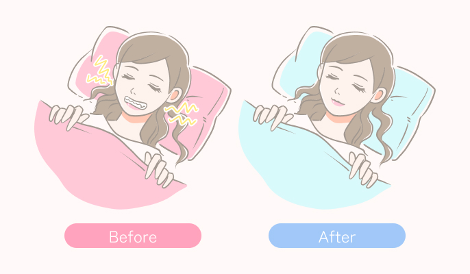 ブラキシズム治療の施術説明