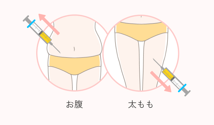 脂肪注入豊胸の施術説明1