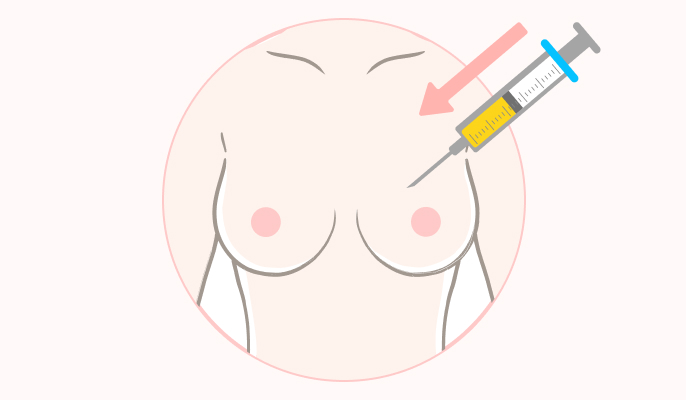 脂肪注入豊胸の施術説明2