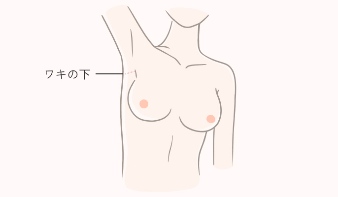 シリコンバッグ豊胸の施術説明1