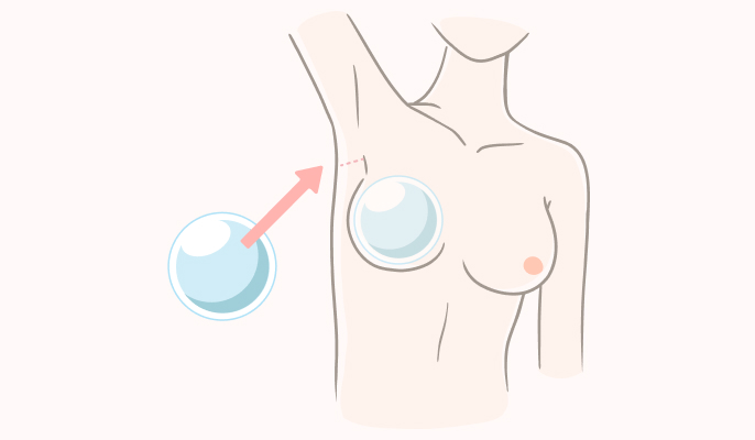 シリコンバッグ豊胸の施術説明2