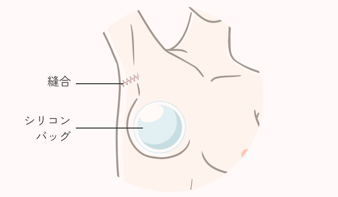シリコンバッグ豊胸の施術説明3
