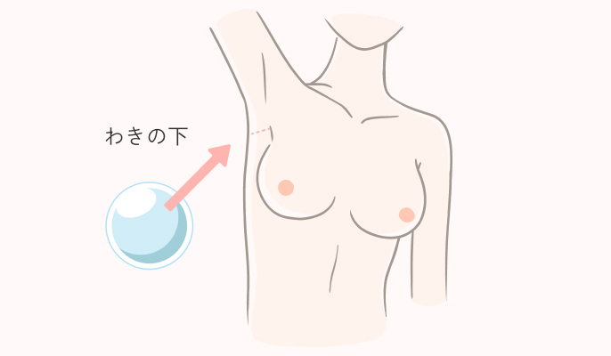 切開箇所_わきの下