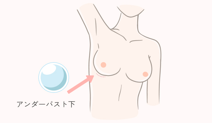切開箇所_アンダーバスト