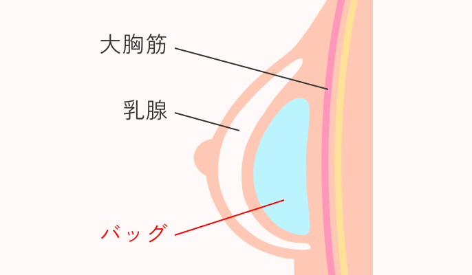 挿入箇所_乳腺の下