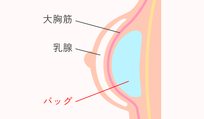 挿入箇所_大胸筋の内側