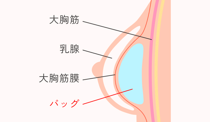挿入箇所_筋膜内