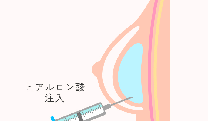 ヒアルロン酸豊胸の施術説明