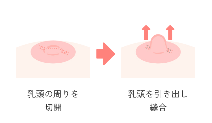 陥没乳頭形成術の説明_乳管を切らない方法