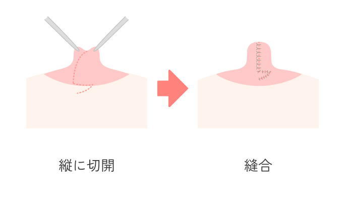 陥没乳頭形成術の説明_乳管を切る方法