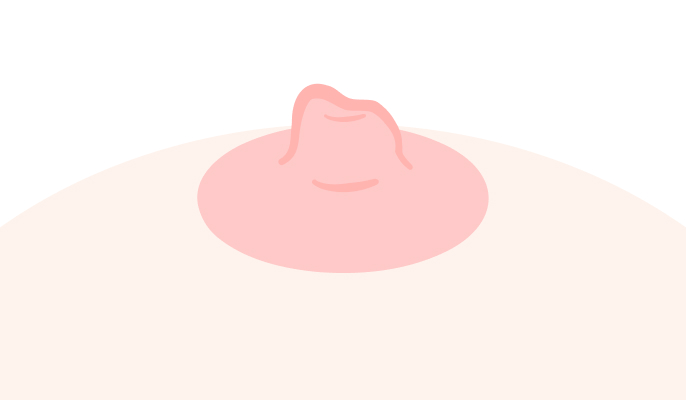 陥没乳頭の種類_仮性