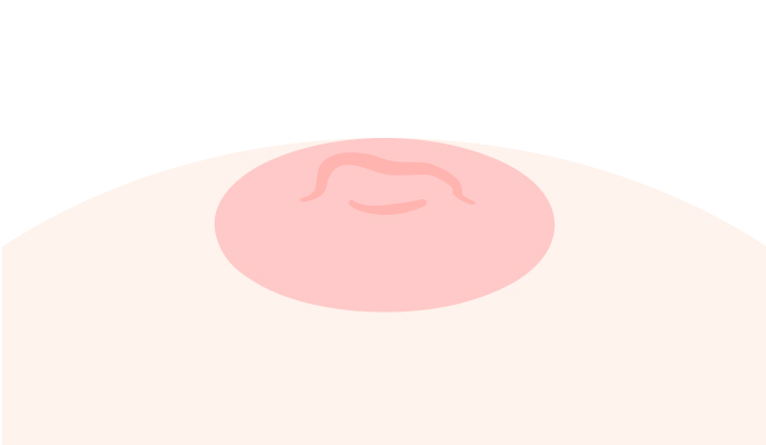 陥没乳頭の種類_真性