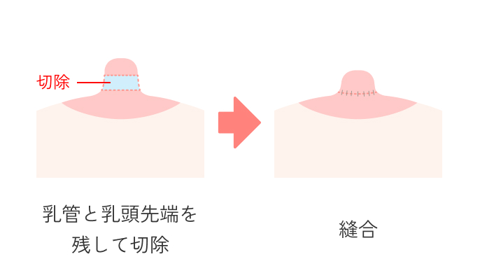乳頭縮小術の説明_授乳機能を温存する場合