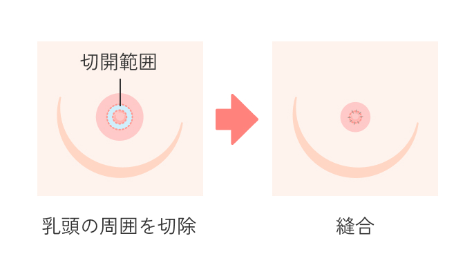 乳輪縮小術の説明_乳頭近く