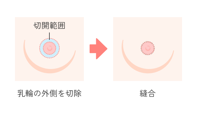 乳輪縮小術の説明_乳輪外側