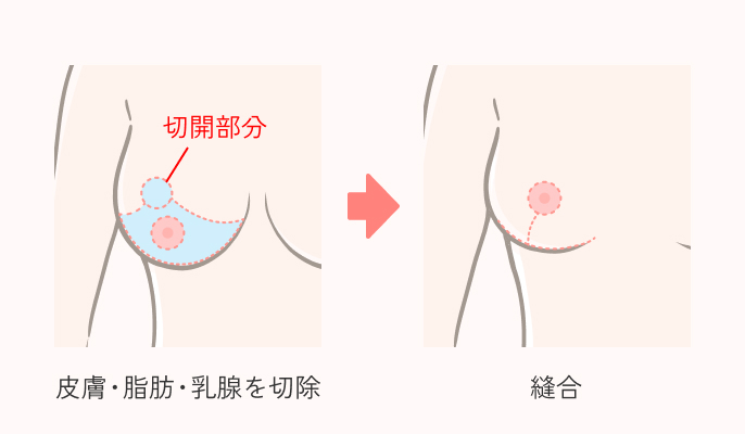 乳房縮小術の説明
