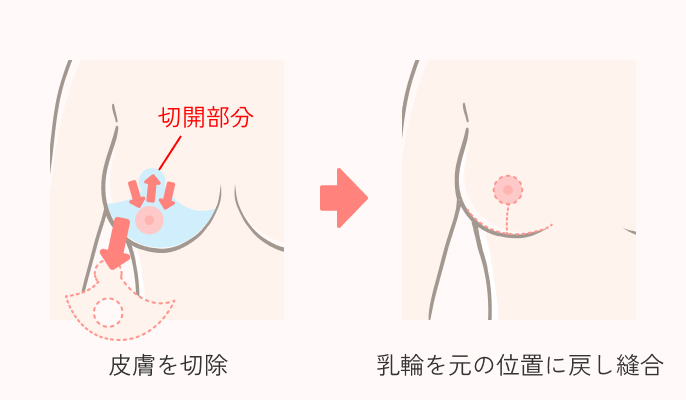 乳房吊り上げ術の説明