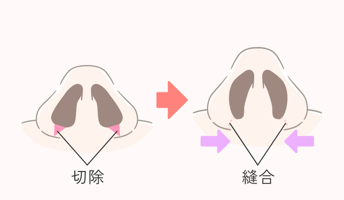 小鼻縮小術の施術説明