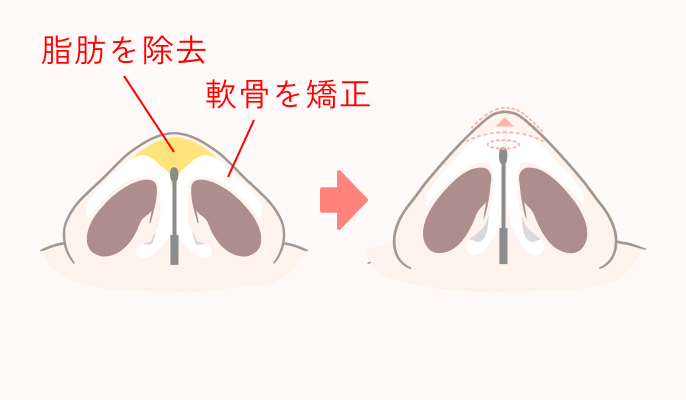 鼻尖縮小術の施術説明