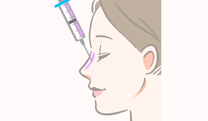 鼻のヒアルロン酸注入の施術説明