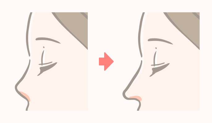 鼻中隔延長の施術説明