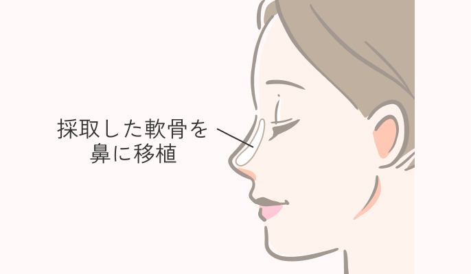 耳介軟骨移植法の施術説明