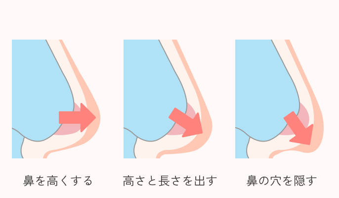 鼻中隔延長術の高さ・角度調整