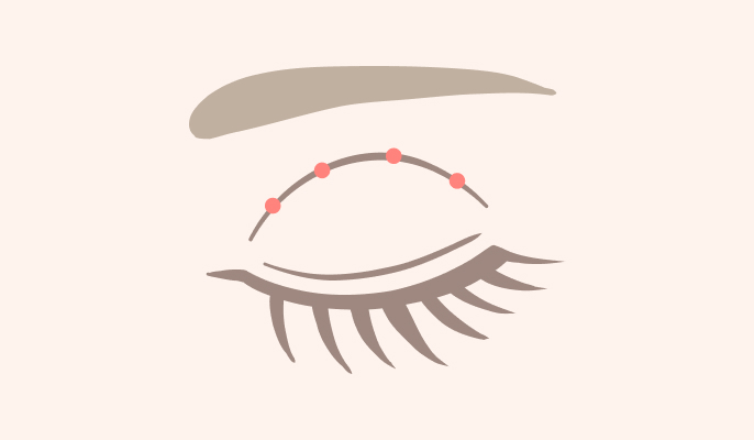 二重埋没の施術説明1