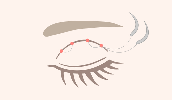 二重埋没の施術説明2