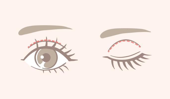 4点自然癒着法（スーパーナチュラル）