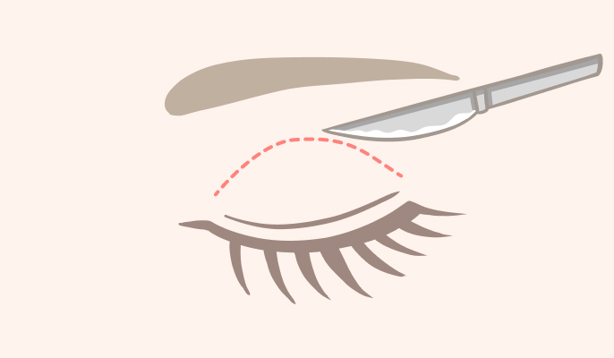 二重切開の施術説明1