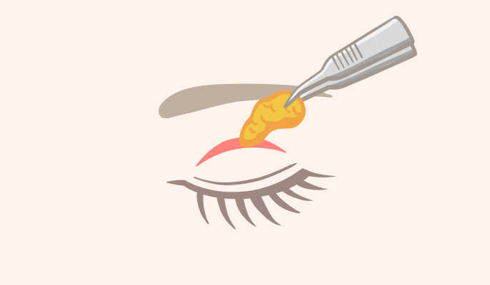 二重切開の施術説明2