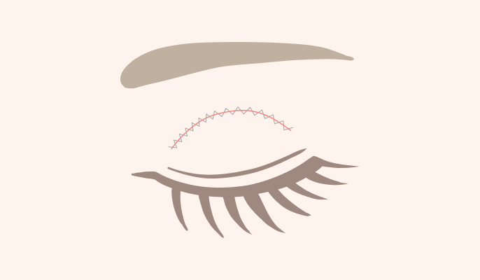 二重切開の施術説明3